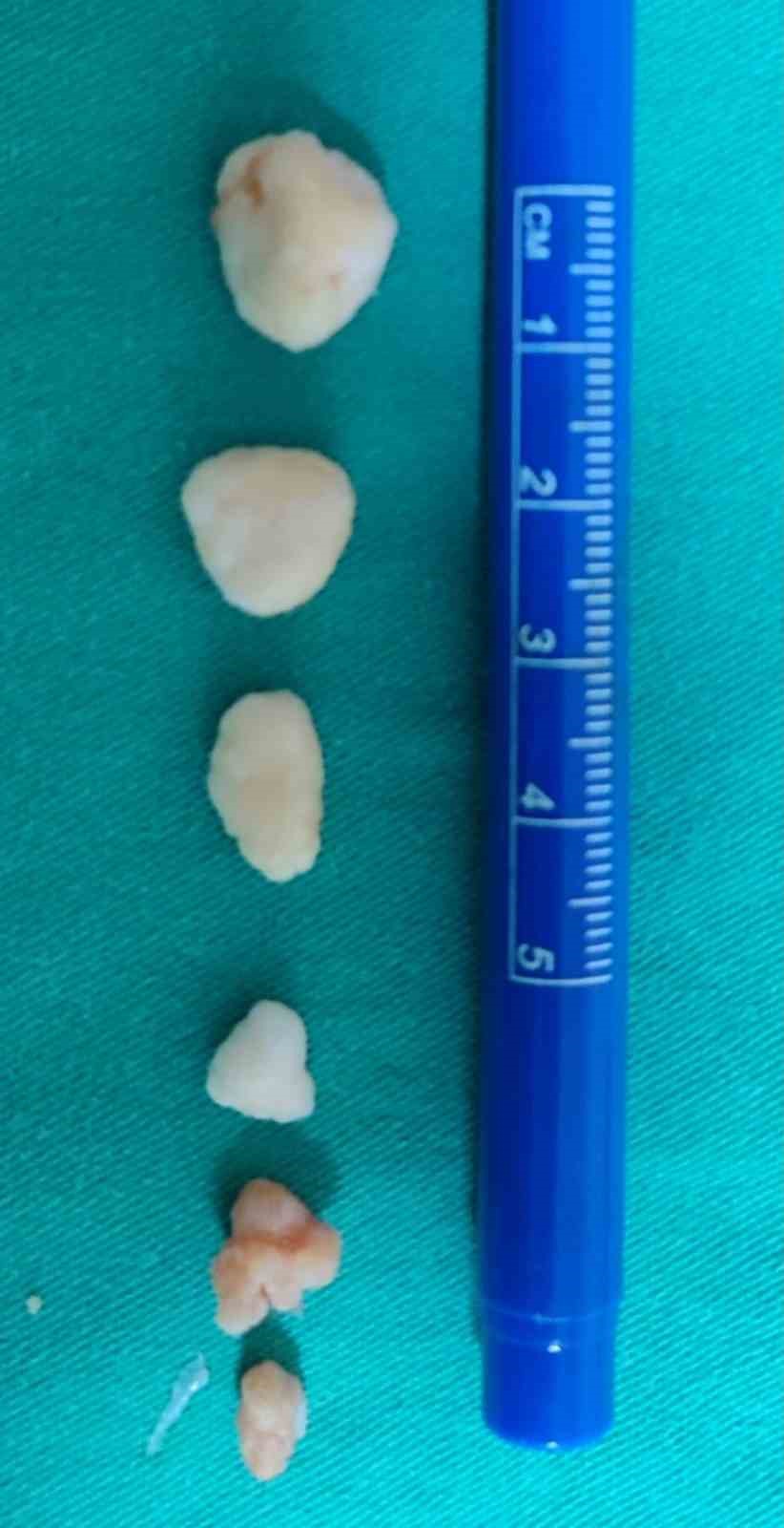 ORTOPEDİ UZMANI OP. DR. MEVLÜT BÜYÜK TARAFINDAN YAPILAN DİRSEK EKLEMİ SİNOVYAL KONDROMATOZİS - DİRSEK ARTROSKOPİSİ OPERASYONUNDA, KAPALI CERRAHİ YÖNTEMLE EKLEME GİRİLEREK HAREKETİ KISITLAYAN SERBEST CİSİMLER ÇIKARILDI.