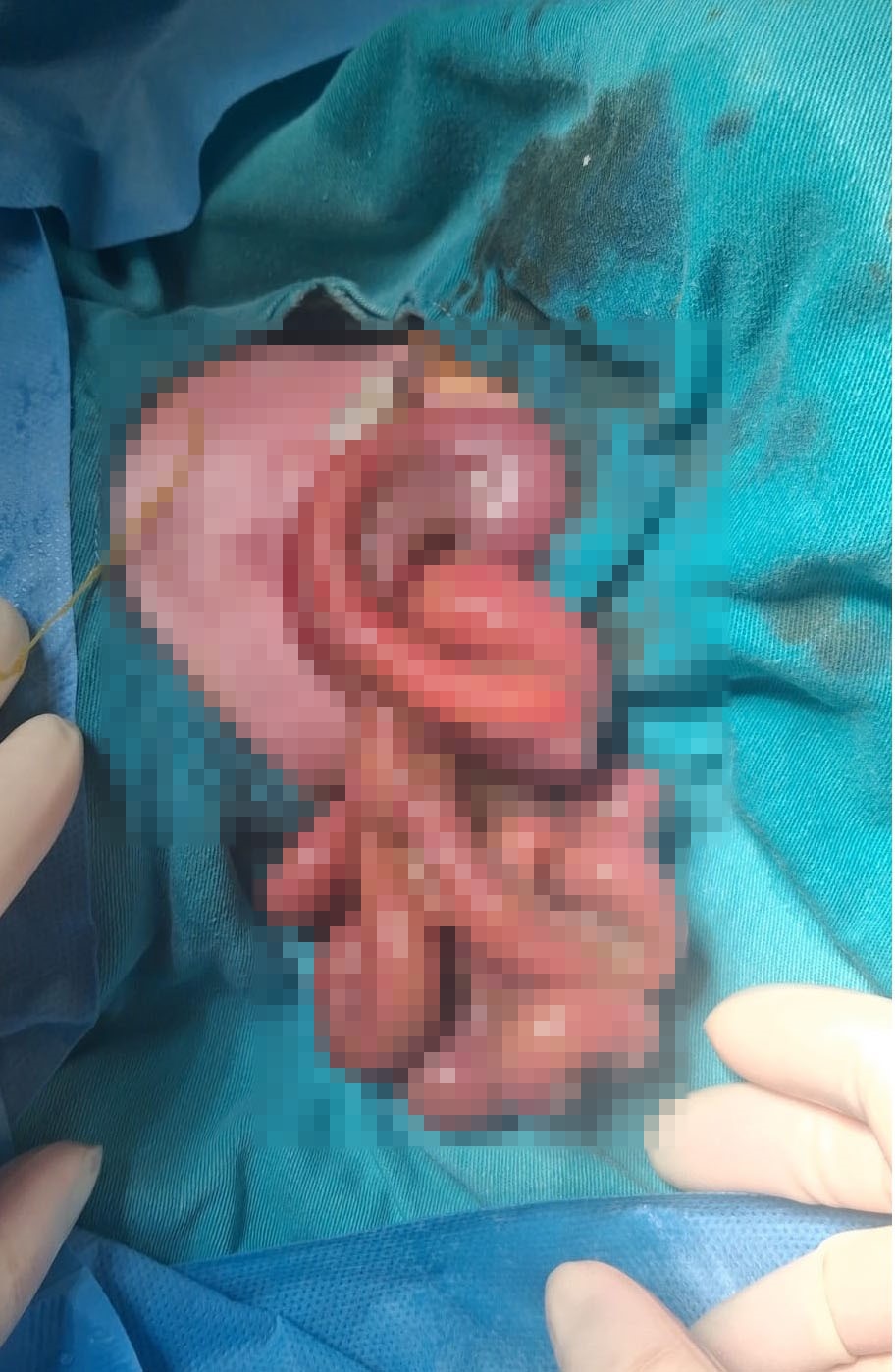TOKAT'TAN SAMSUN'A SEVK EDİLEN, ORGANLARI DIŞARIDA DÜNYAYA GELEN MAHMUT TALHA BEBEK, YAKLAŞIK 1,5 AY SÜREN YOĞUN TEDAVİ VE BAŞARILI AMELİYATLARIN ARDINDAN SAĞLIĞINA KAVUŞTU.